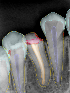 2.Handy AI Tooth Structure Analysis