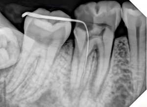 HDR-380 lower molars