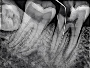 HDR-500 lower molars 1