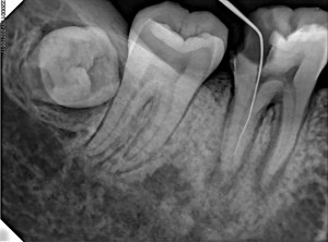 HDR-600 lower molars-1